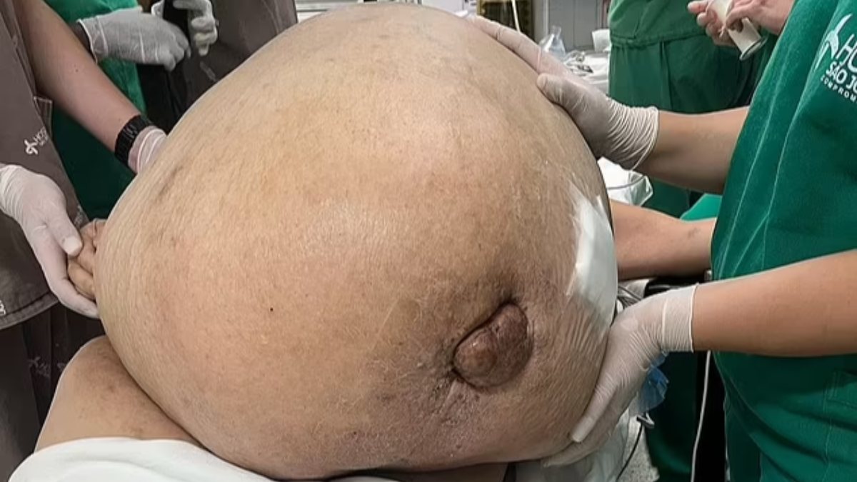 Docs in Brazil removed a forty five-pound tumor in 2 hours