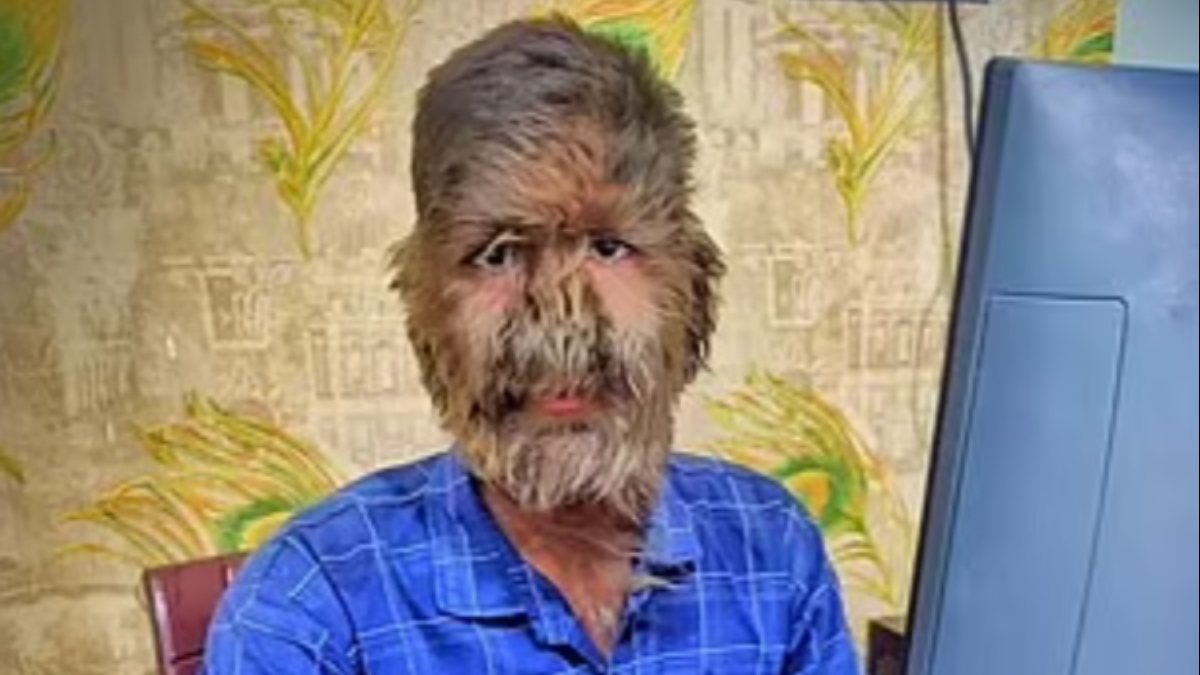 17-yr-antique in India turns into a werewolf as a result of illness